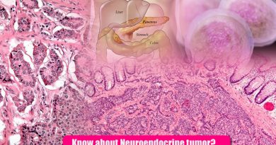 Know about Neuroendocrine tumor, its symptoms and types!
