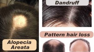 Know about Hair and about Alopecia areata, Pattern hair loss and Dandruff