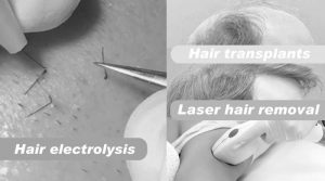 Know about Hair and Hair transplants, Hair electrolysis and Laser hair removal