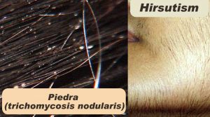 Know about Hair and about Piedra, trichomycosis nodularis and Hirsutism