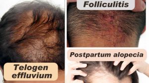 Know about Hair and about Telogen effluvium, Postpartum alopecia and Folliculitis