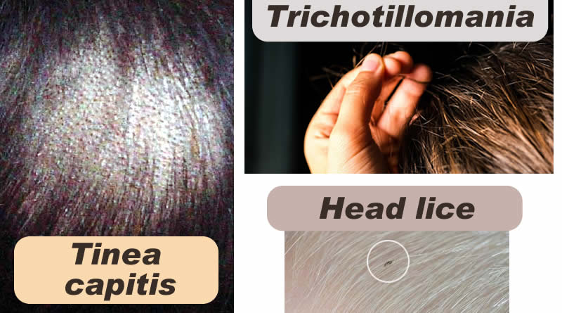 Know about Hair and about Tinea capitis, Trichotillomania and Head-lice