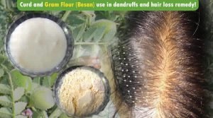 Curd and Besan (Gram Flour) use in dandruffs and hair loss remedy!